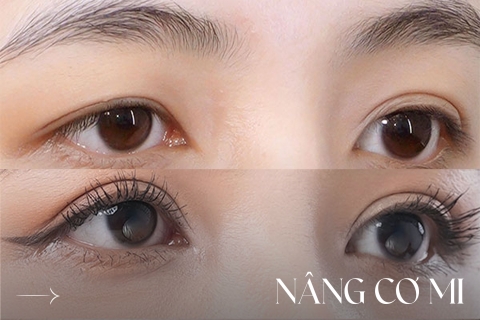 Nâng cơ mi